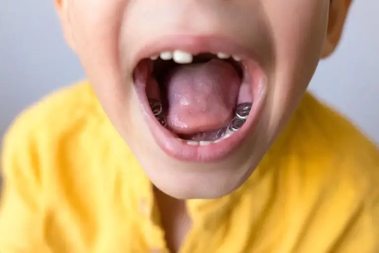 Stainless Steel Crowns for Kids Under Sedation