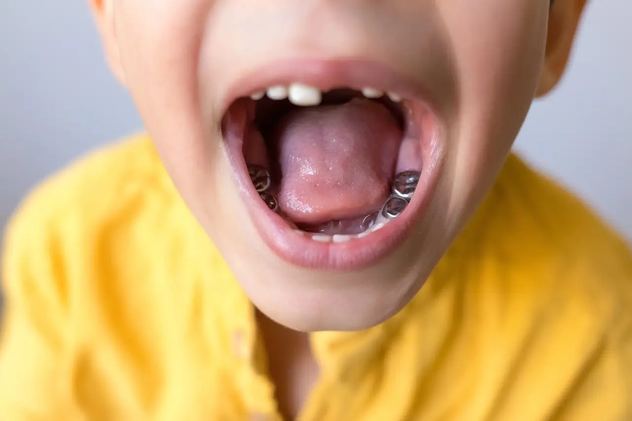 Child showing stainless steel crowns