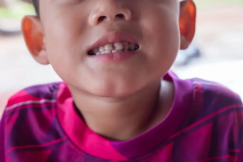 Child with a missing baby tooth